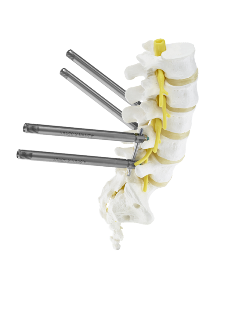 EUROPA Open & MIS Thoracolumbar Pedicle Screw System features