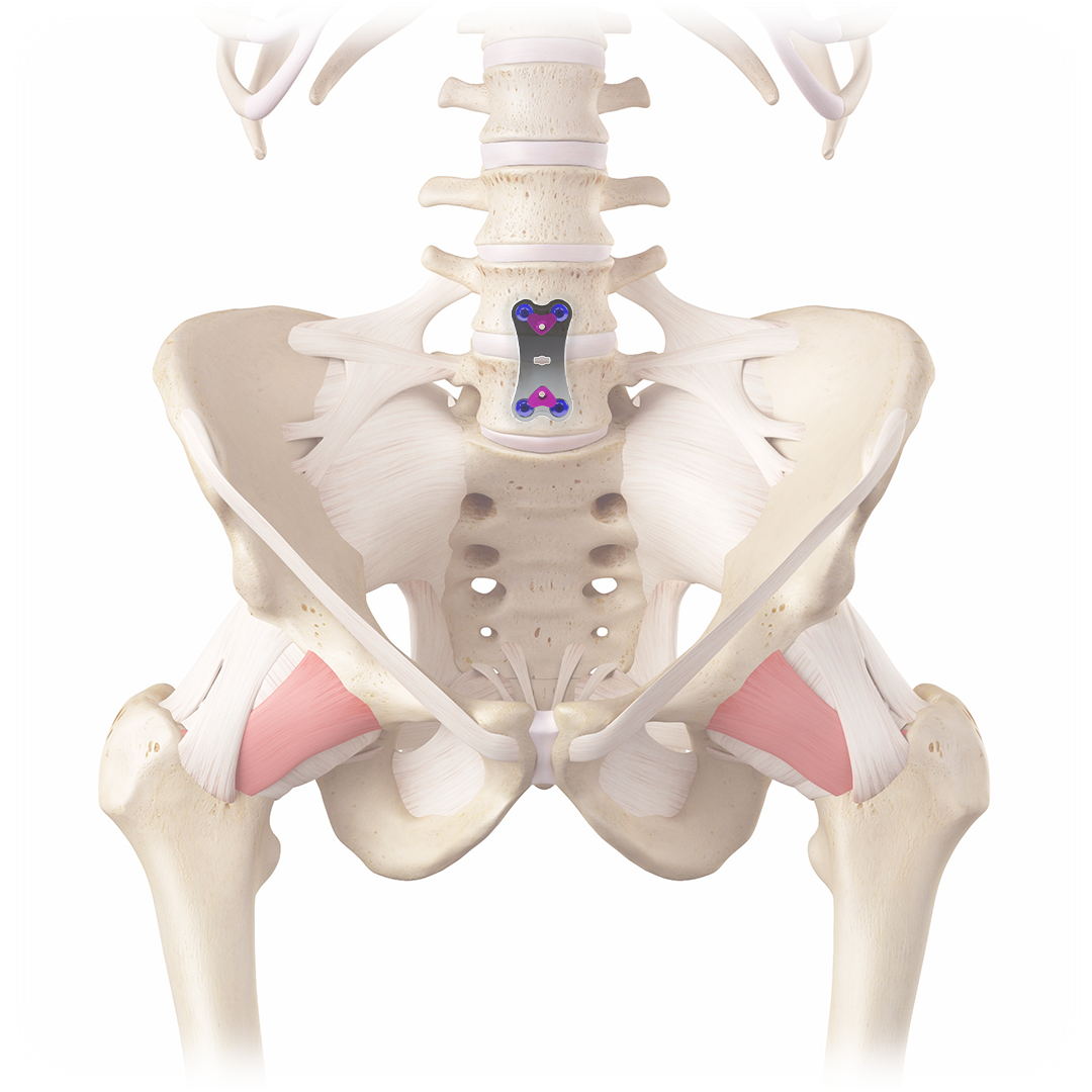 Antares MoRe Plate on Spine