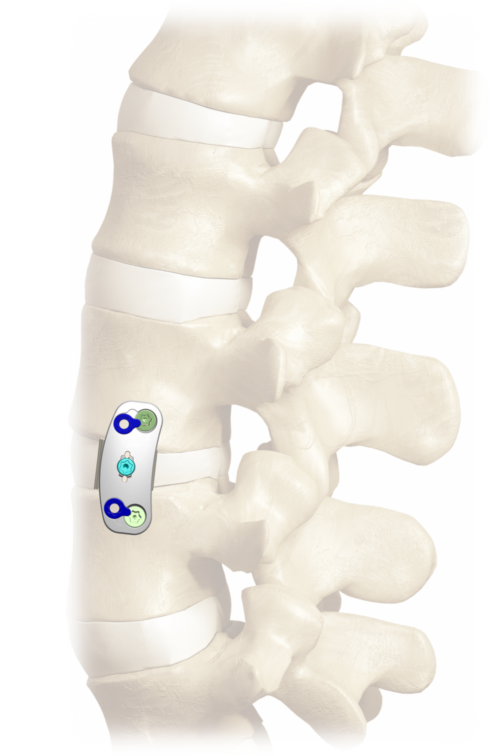 Lateral Plate on Spine2 Lateral Plate on Spine2